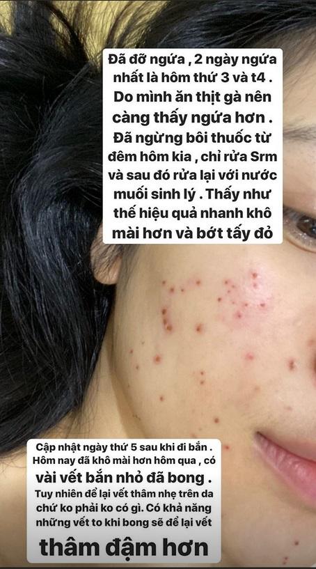 Không ngại xấu, Hòa Minzy công khai gương mặt sau 11 ngày bắn laser mụn thịt-8