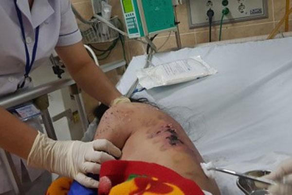 Nữ tiếp viên tố bị chủ quán cà phê ở Đồng Nai chích điện, đánh gãy xương sườn,&nbsp;nứt sọ...-2