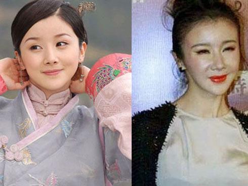 Sao Hoa ngữ và những cái kết đau đớn do phẫu thuật thẩm mỹ-3