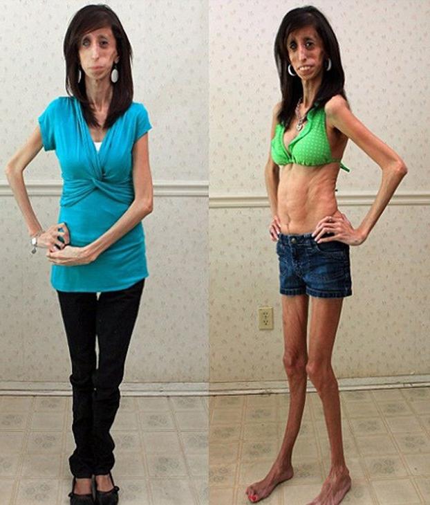 Sau 31 năm, phép màu đã đến với cô gái từng bị gọi xấu xí nhất thế giới-4