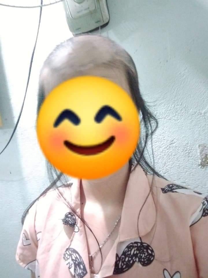 Cô gái trẻ kể chuyện nhổ tóc mỗi khi stress, nhìn ảnh đầu ơi ở lại tóc đi nhé ai cũng hết hồn-2