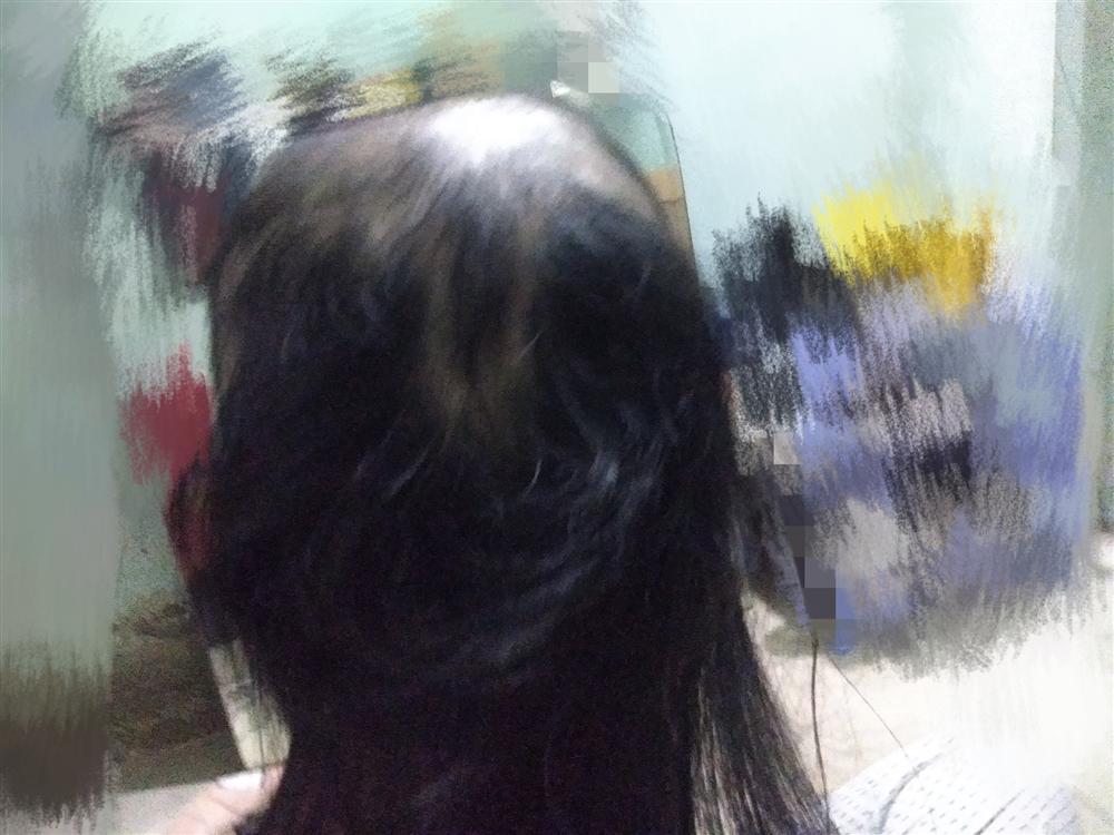 Cô gái trẻ kể chuyện nhổ tóc mỗi khi stress, nhìn ảnh đầu ơi ở lại tóc đi nhé ai cũng hết hồn-4