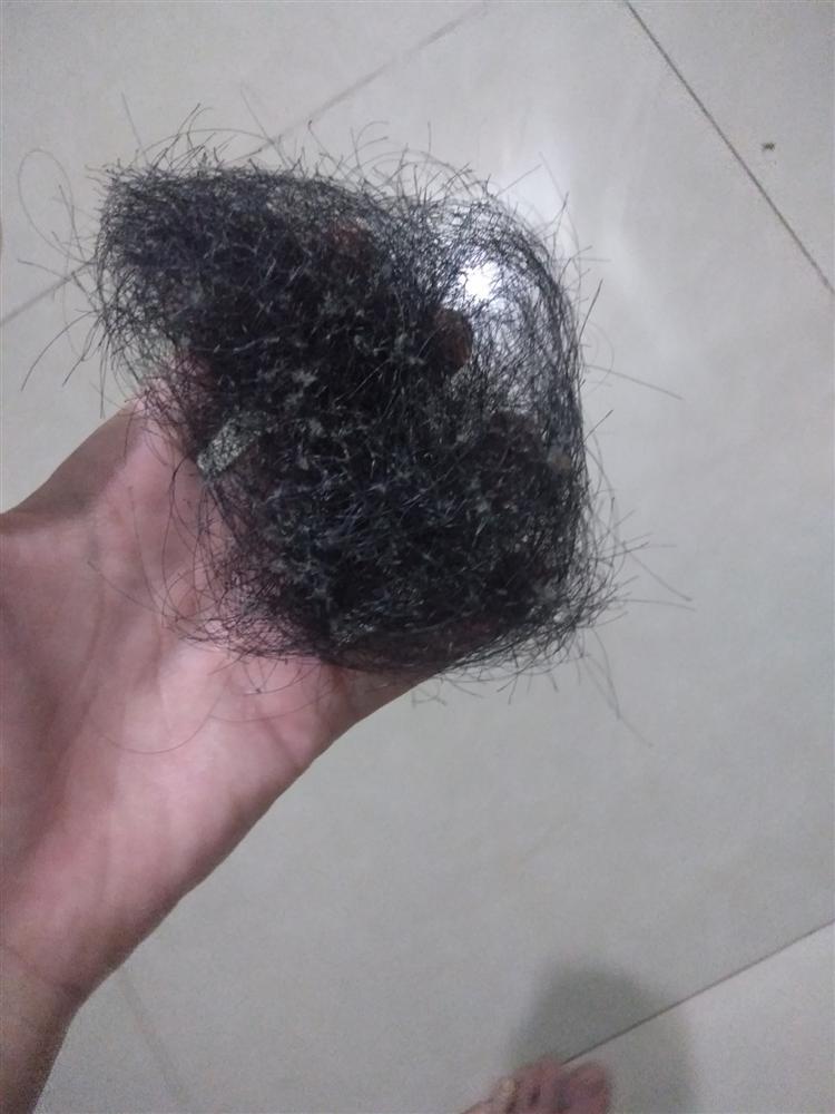 Cô gái trẻ kể chuyện nhổ tóc mỗi khi stress, nhìn ảnh đầu ơi ở lại tóc đi nhé ai cũng hết hồn-3