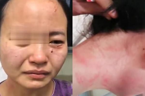 Nữ y tá bị cắn rách mặt khi ngăn cản bệnh nhân nhiễm COVID-19 trốn cách ly-1