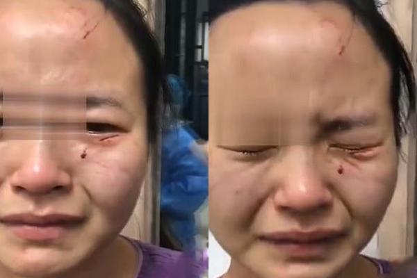 Nữ y tá bị cắn rách mặt khi ngăn cản bệnh nhân nhiễm COVID-19 trốn cách ly-2
