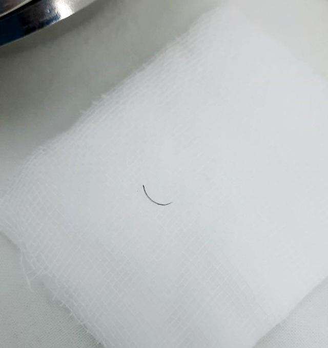 Bỏ quên kim khâu trong mí mắt bệnh nhân gần 2 năm-2