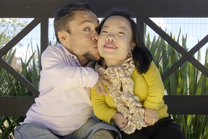 Chuyện tình cảm động của chàng trai với 2 chị em song sinh dính liền thân-1