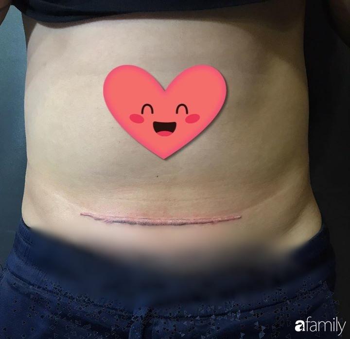 Thương vợ mang nặng đẻ đau 2 lần, ông bố trẻ Hà Nội âm thầm xăm vết sẹo mổ y hệt vợ động viên bà xã-6