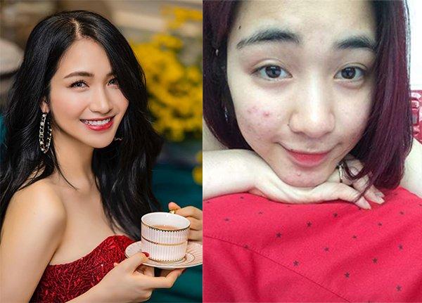Bảnh bao như Trấn Thành, xinh đẹp như Hoà Minzy cũng không thoát khỏi lời nguyền bị mụn đeo bám-4