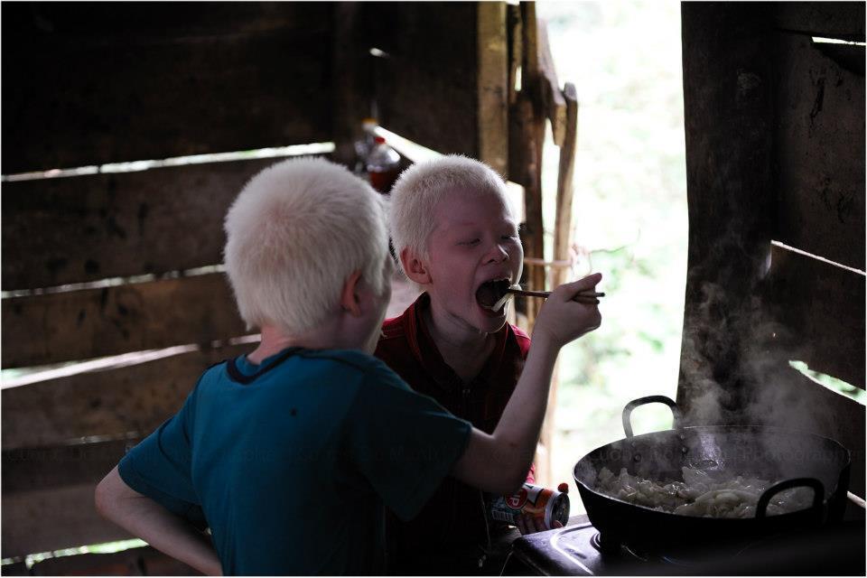 Cuộc sống thay đổi khó tin của cặp song sinh bạch tạng ở Hà Tĩnh sau 7 năm nổi tiếng-2