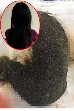 Kinh hoàng: Bé gái 11 tuổi ở Hà Nội có khối u lớn toàn... tóc trong dạ dày