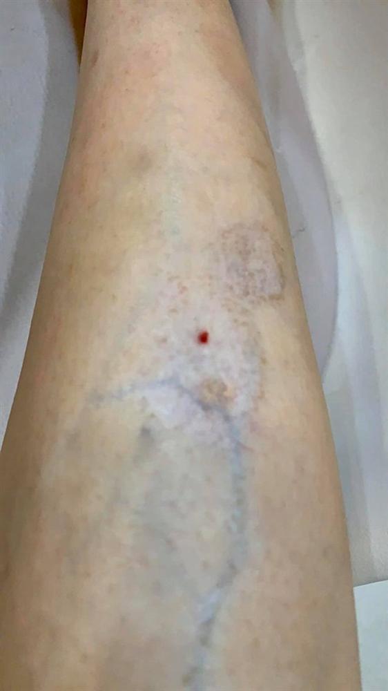 Người nổi tiếng từng gặp biến chứng sau dao kéo, có người phải sống mãi với gương mặt đáng sợ-2