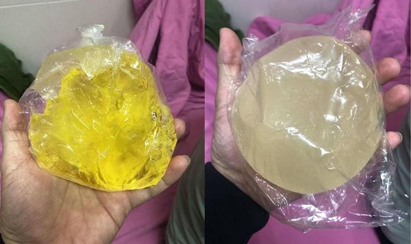 Người nổi tiếng từng gặp biến chứng sau dao kéo, có người phải sống mãi với gương mặt đáng sợ-4