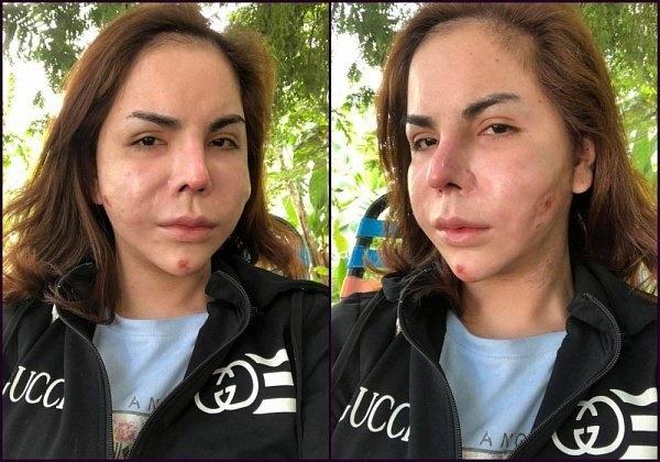 Người nổi tiếng từng gặp biến chứng sau dao kéo, có người phải sống mãi với gương mặt đáng sợ-21