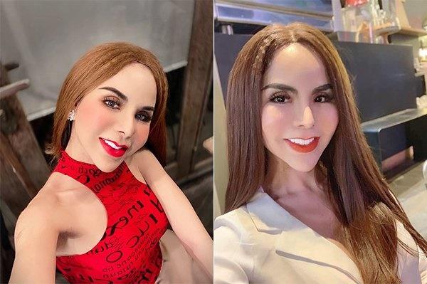 Người nổi tiếng từng gặp biến chứng sau dao kéo, có người phải sống mãi với gương mặt đáng sợ-22