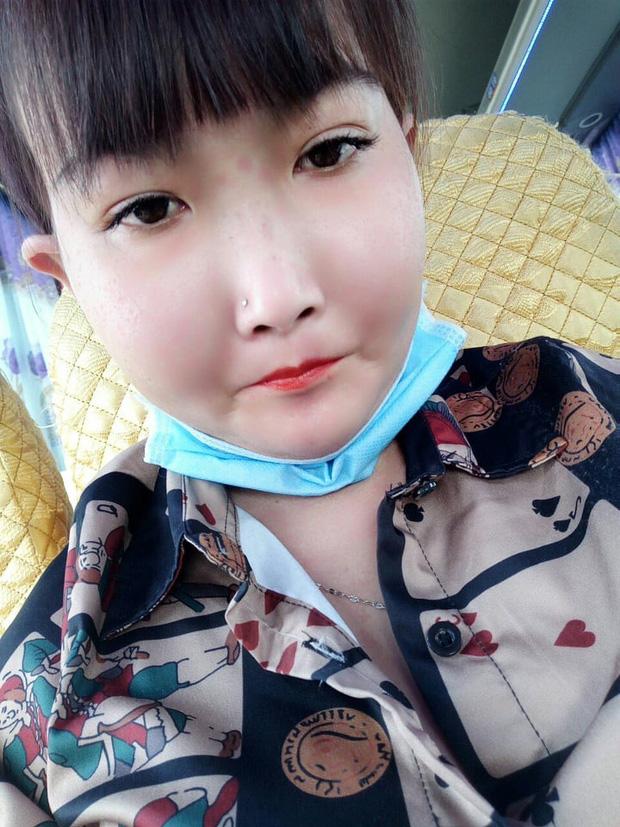 Cô gái Bến Tre mắc bệnh xơ cứng bì quay clip tiktok hút 2 triệu view: Gia cảnh khó khăn, bị trêu chọc vì gương mặt kì lạ-4