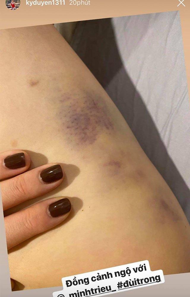 Đến vết bầm tím cũng có đôi, chân dài nõn nà của Kỳ Duyên - Minh Triệu nay còn đâu?-1
