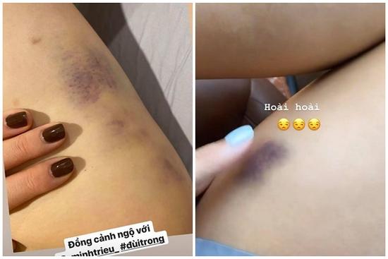 Đến vết bầm tím cũng có đôi, chân dài nõn nà của Kỳ Duyên - Minh Triệu nay còn đâu?