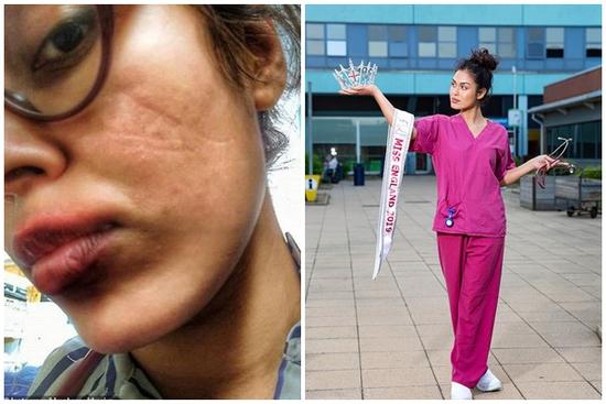 Mặt hoa hậu Anh bị tổn thương vì đeo khẩu trang