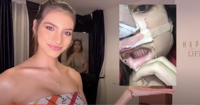 Hoa hậu Hòa bình thừa nhận thẩm mỹ, hình ảnh đập mặt xây lại gây ám ảnh-1