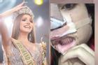 Hoa hậu Hòa bình thừa nhận thẩm mỹ, hình ảnh 'đập mặt xây lại' gây ám ảnh