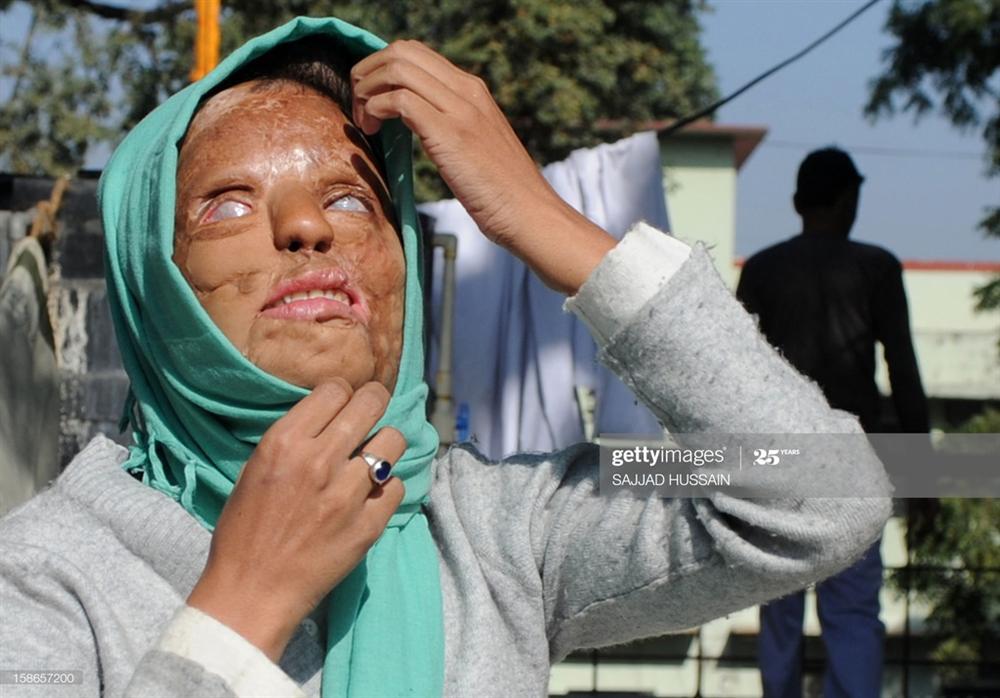 Cô gái bị tạt axit thắng ở Ai là triệu phú 8 năm trước giờ ra sao-5