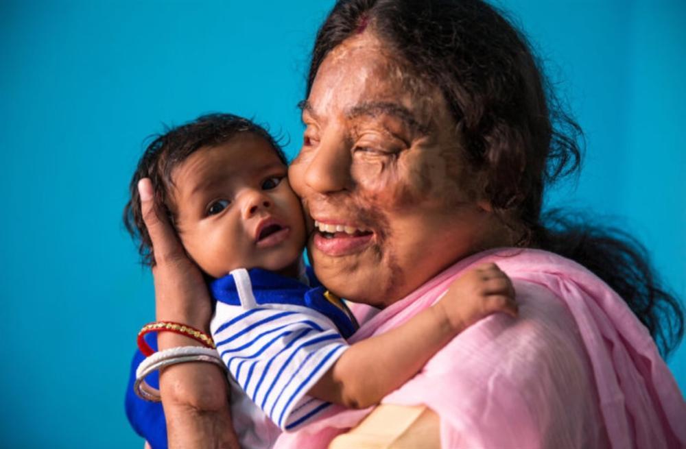 Cô gái bị tạt axit thắng ở Ai là triệu phú 8 năm trước giờ ra sao-8