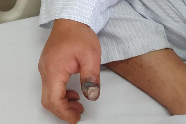 Sai lầm chết người khi sơ cứu nạn nhân bị rắn độc cắn-1