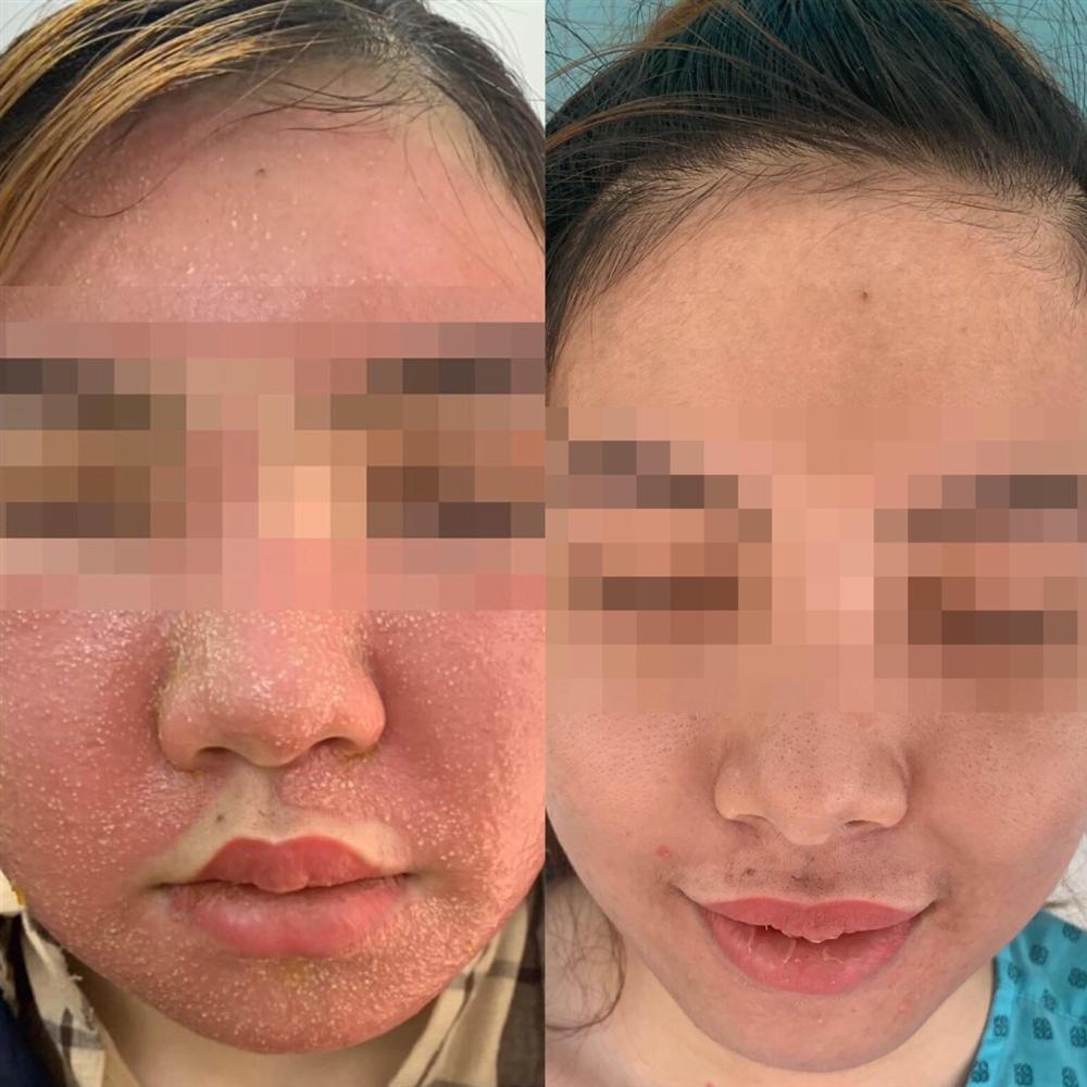 Cô gái mua mặt nạ đông y 600.000 tưởng sẽ trắng mịn, ai ngờ dở sống dở chết khi nhìn mặt mình-1