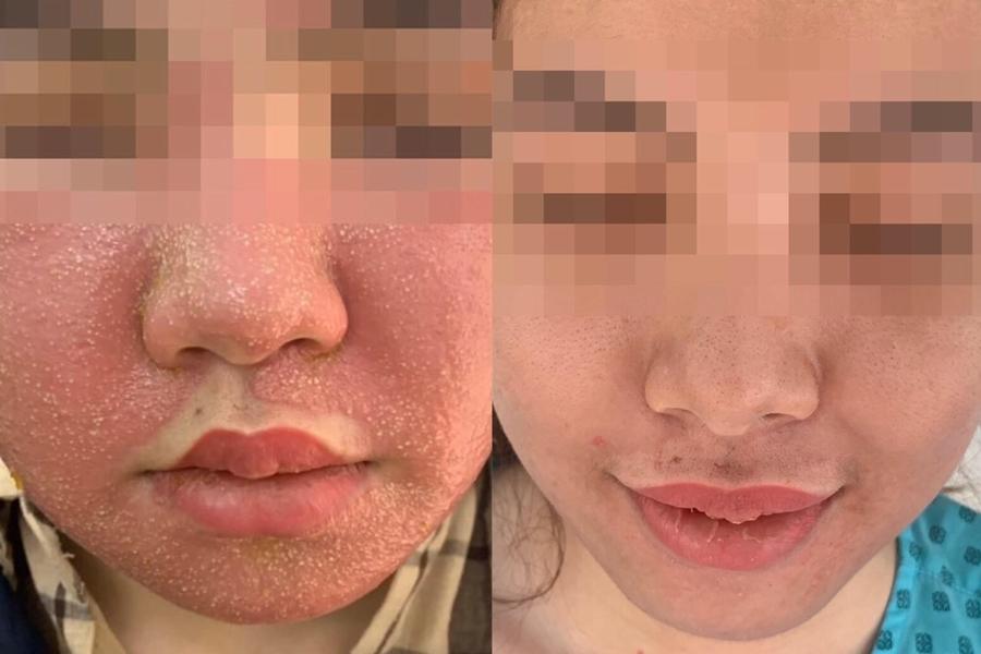 Những ca xóa xăm vừa đau đớn vừa hỏng da vĩnh viễn khiến bạn cần cân nhắc khi xăm hình-7