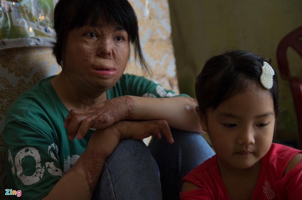 Cuộc sống của cô gái trẻ Hà Nội sau 4 năm bị chồng tẩm xăng thiêu sống-5