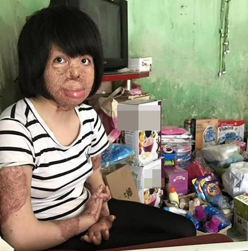 Cuộc sống của cô gái trẻ Hà Nội sau 4 năm bị chồng tẩm xăng thiêu sống-3