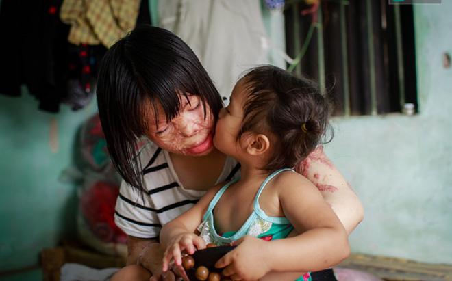 Cuộc sống của cô gái trẻ Hà Nội sau 4 năm bị chồng tẩm xăng thiêu sống-4