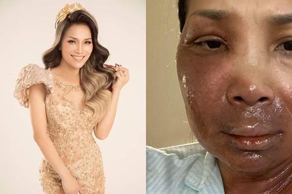 Trước Hồng Ngọc, Hồ Ngọc Hà - Lê Dương Bảo Lâm - Khả Như cũng từng bị bỏng nặng vì tai nạn nghề nghiệp-8