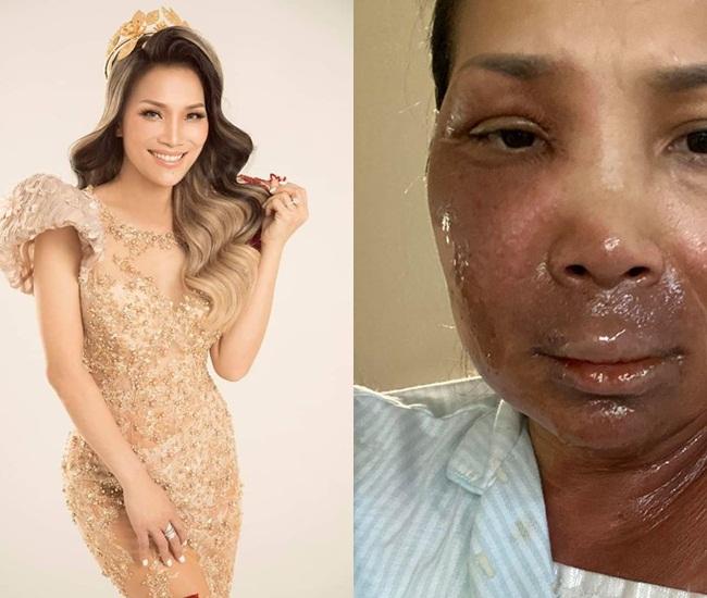 Trước Hồng Ngọc, Hồ Ngọc Hà - Lê Dương Bảo Lâm - Khả Như cũng từng bị bỏng nặng vì tai nạn nghề nghiệp-1