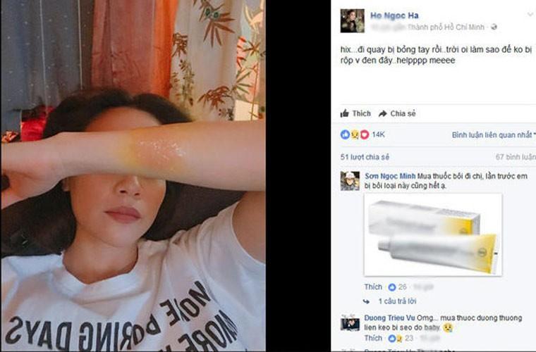 Trước Hồng Ngọc, Hồ Ngọc Hà - Lê Dương Bảo Lâm - Khả Như cũng từng bị bỏng nặng vì tai nạn nghề nghiệp-7