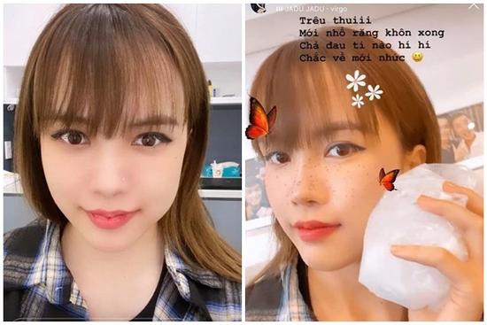 Thiều Bảo Trâm bất ngờ đăng ảnh mặt sưng vù, thừa nhận tiêm má?