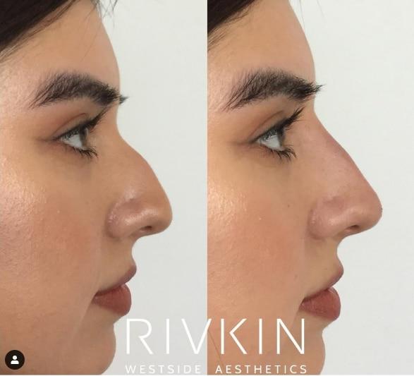 Bác sĩ phát minh ra tiêm filler chia sẻ 5 sự thật về việc sửa mũi-3