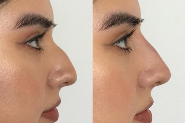 Người mẫu Ukraine nghiện tiêm filler đến biến dạng mặt-4