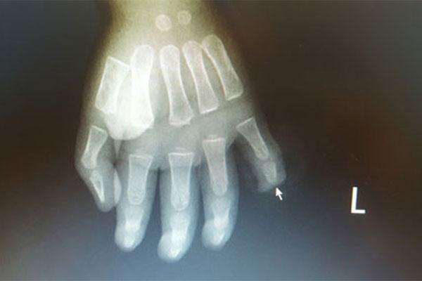 Cha mẹ bất cẩn, con 17 tháng tuổi nghịch dao đứt rời đốt ngón tay-1