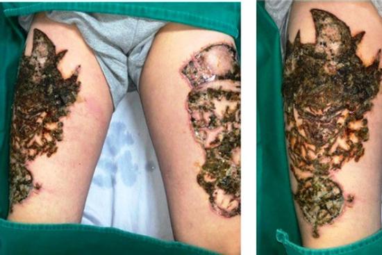 Hà Nội: Nam thanh niên 'nát bét' hai đùi vì biến chứng xóa xăm