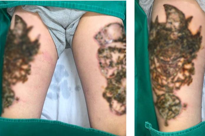 Những ca xóa xăm vừa đau đớn vừa hỏng da vĩnh viễn khiến bạn cần cân nhắc khi xăm hình-1