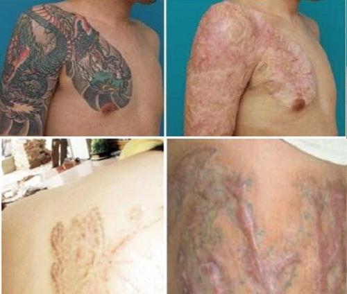 Những ca xóa xăm vừa đau đớn vừa hỏng da vĩnh viễn khiến bạn cần cân nhắc khi xăm hình-2
