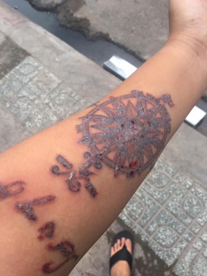 Những ca xóa xăm vừa đau đớn vừa hỏng da vĩnh viễn khiến bạn cần cân nhắc khi xăm hình-4