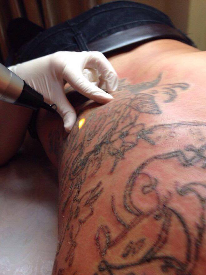 Những ca xóa xăm vừa đau đớn vừa hỏng da vĩnh viễn khiến bạn cần cân nhắc khi xăm hình-5