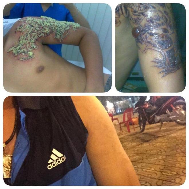 Những ca xóa xăm vừa đau đớn vừa hỏng da vĩnh viễn khiến bạn cần cân nhắc khi xăm hình-6