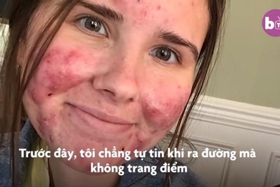 Cô gái sống chung với mụn truyền cảm hứng cho nhiều người
