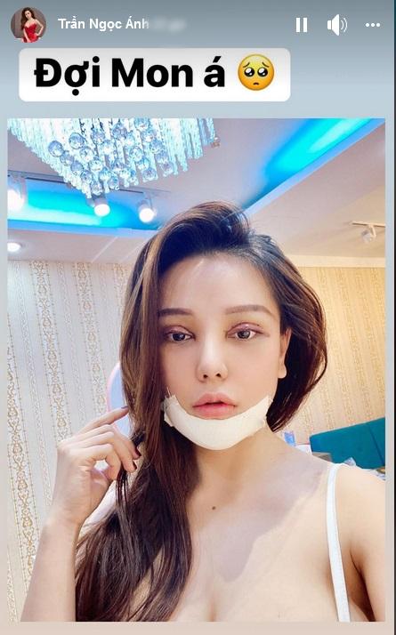 Mon 2k khoe gương mặt sưng, băng bó chằng chịt vì nhấn mí, làm cằm-1