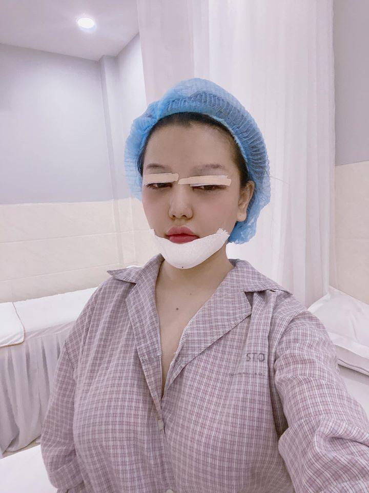 Mon 2k khoe gương mặt sưng, băng bó chằng chịt vì nhấn mí, làm cằm-2