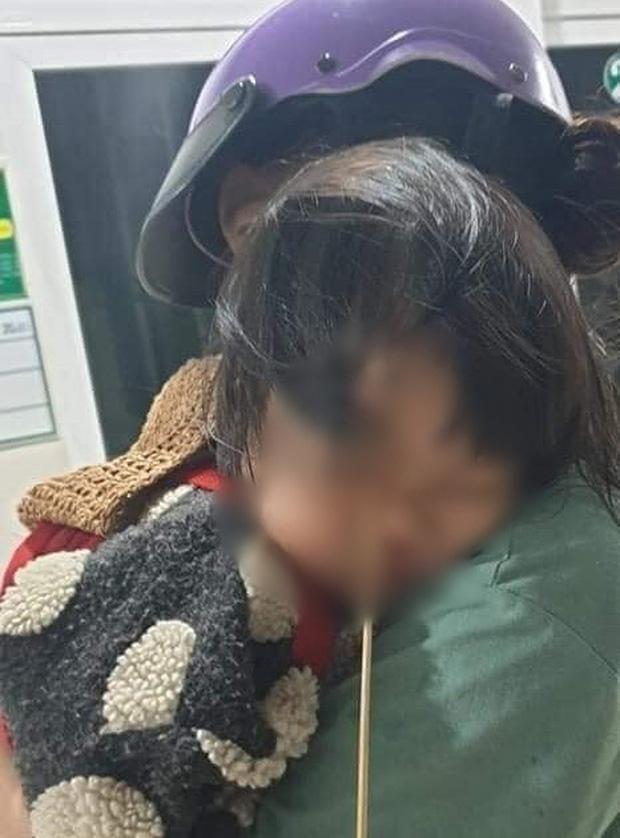 Đang ăn kem thì vấp ngã, bé gái 2 tuổi bị que kem chọc xuyên hốc mắt-1